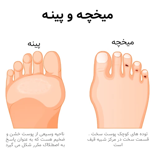 تفاوت میخچه و پینه