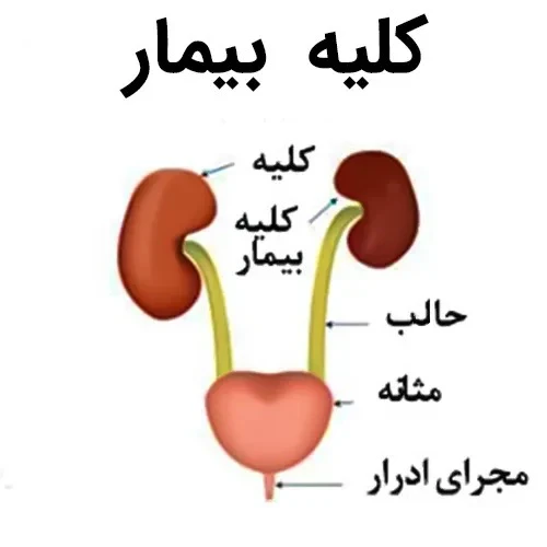 بیماری های کلیوی از موارد احتیاطی مصرف داروی دیازید