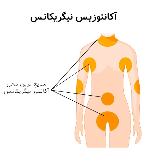 بروز علائم آکانتوزیس نیگریکانس در نقاط خاصی از بدن