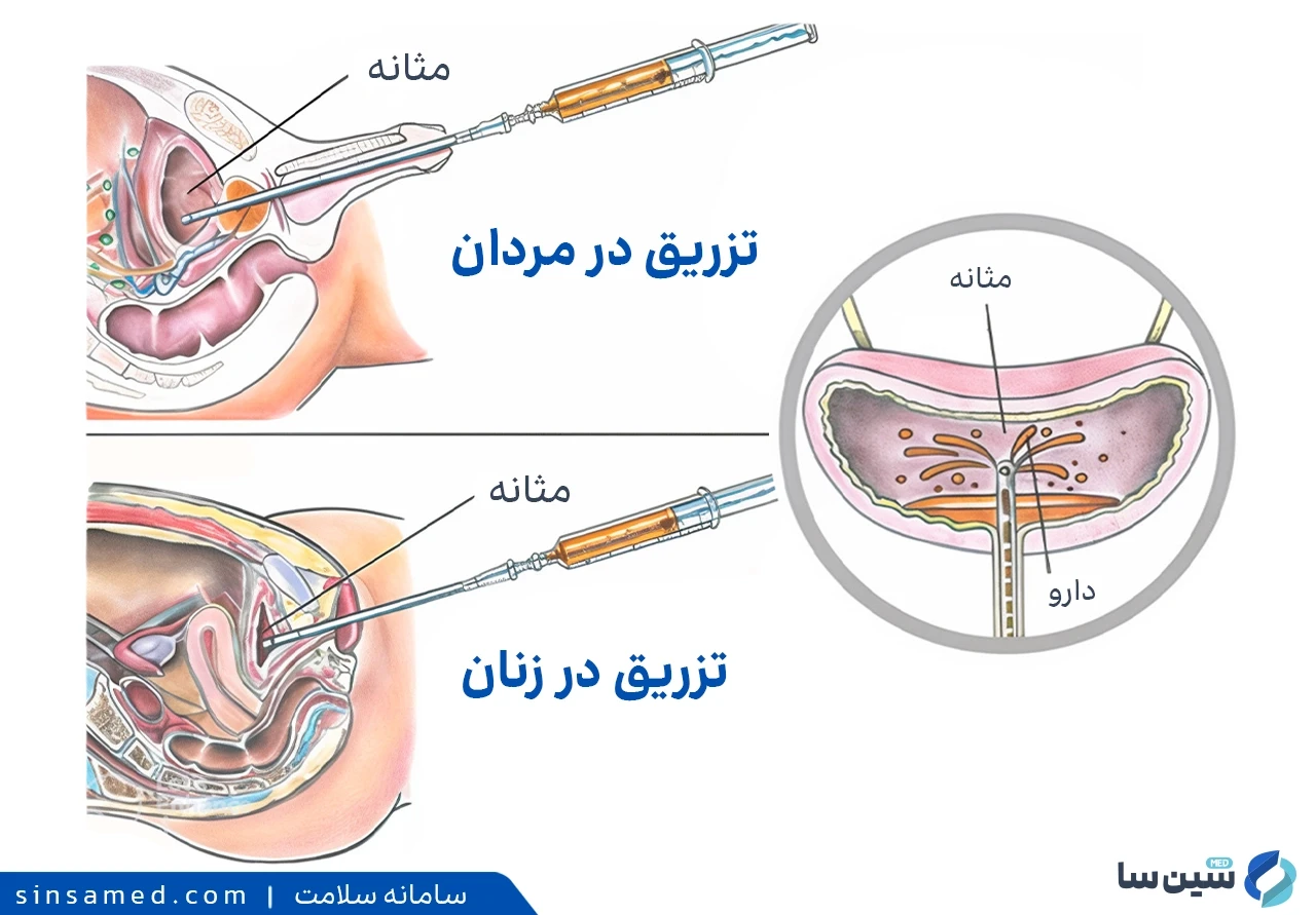 نحوه تزریق آمپول ب ث ژ در مثانه