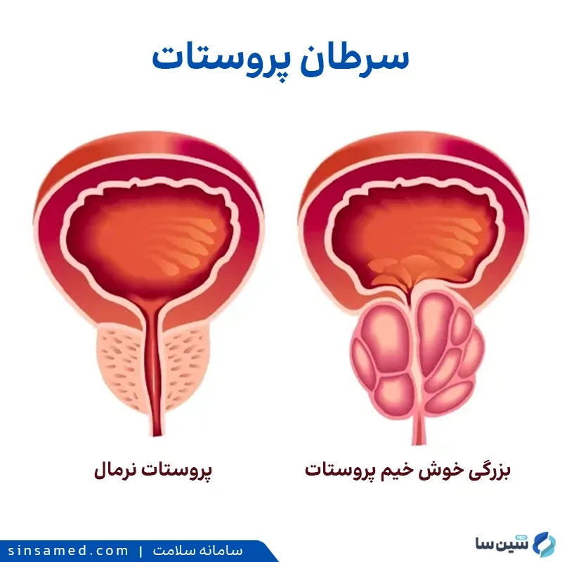 سرطان پروستات