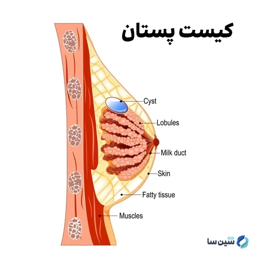 کیست های پستانی