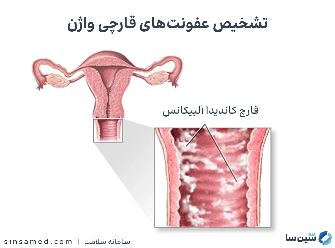 تشخیص عفونت های قارچی واژن