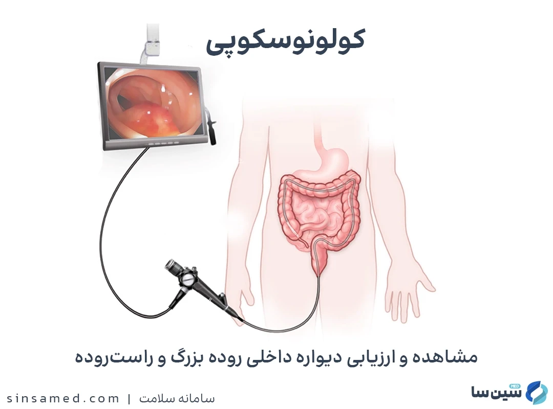 مشاهده و ارزیابی دیواره های داخلی روده بزرگ با کولونوسکوپی