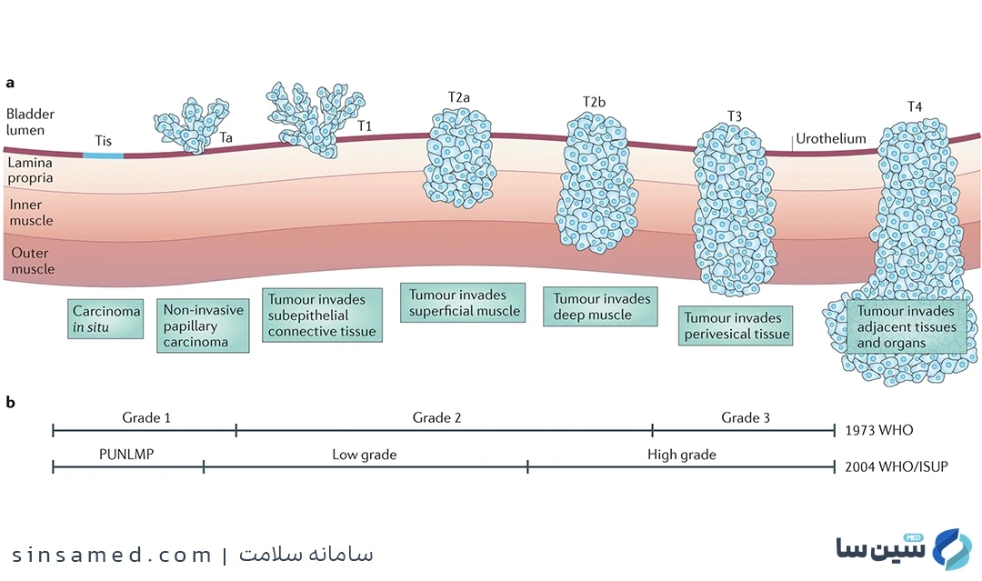 مرحله بندی سرطان