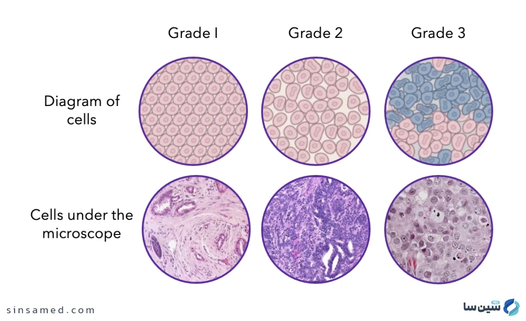 درجه بندی سرطان