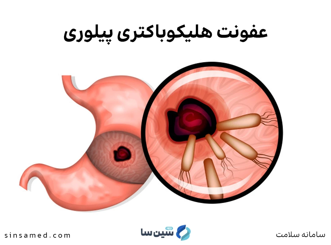 عفونت هلیکوباکتری پیلوری