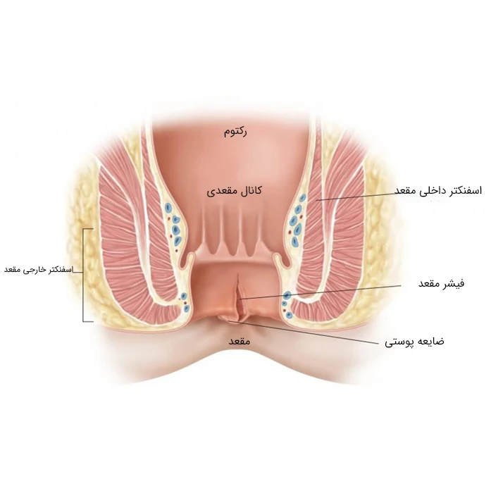 شقاق مقعدی (فیشر مقعدی)