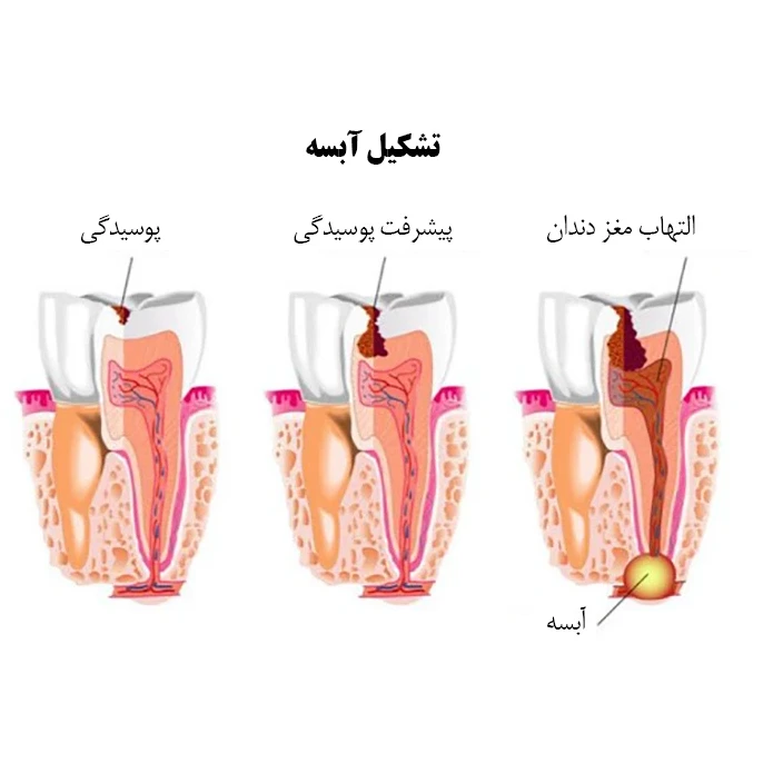 عکس آبسه دندان