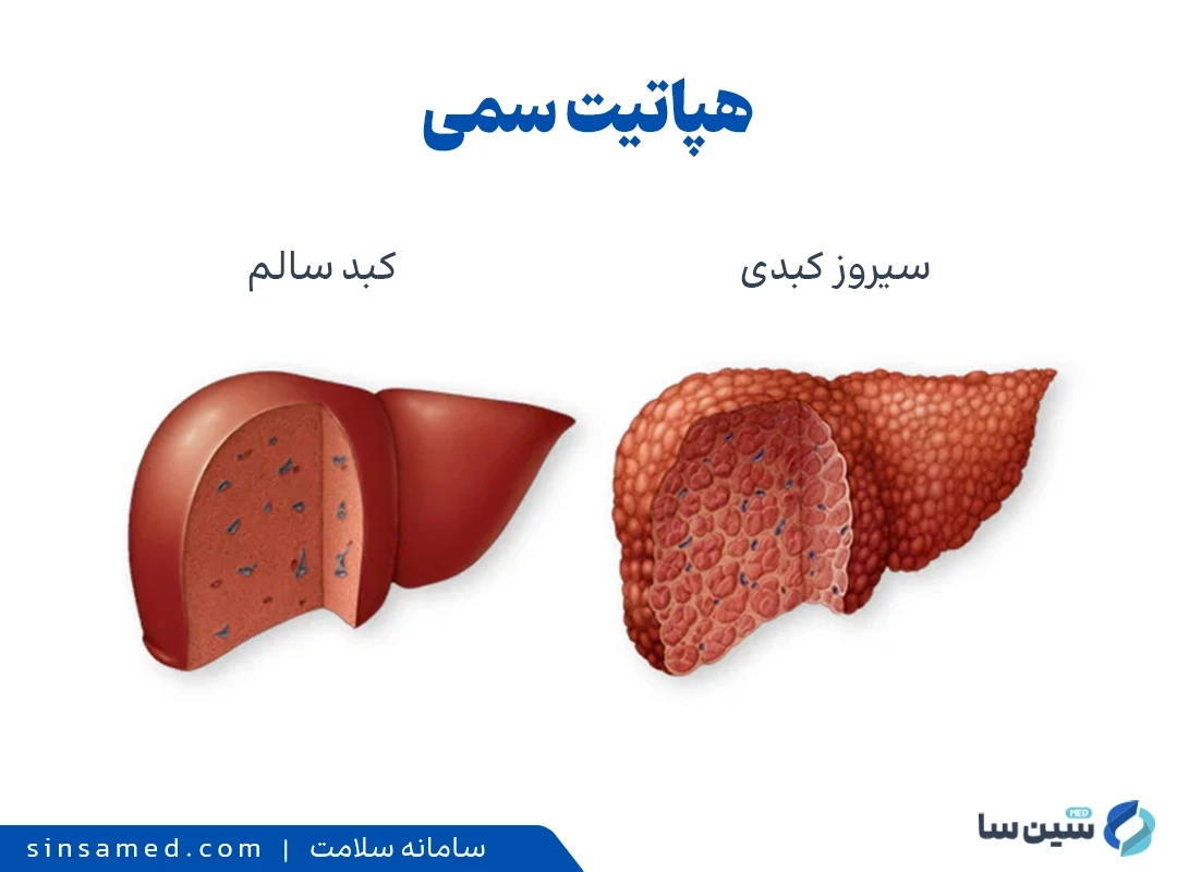 هپاتیت سمی چیست؟