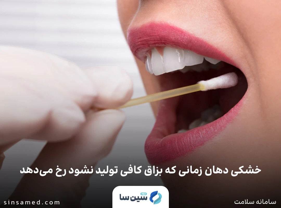 عدم ترشح بزاق از علل ابتلا به خشکی دهان