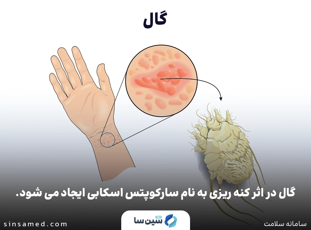 بروز بیماری گال به دلیل نفوذ کنه سارکوپتس اسکیبی به داخل پوست