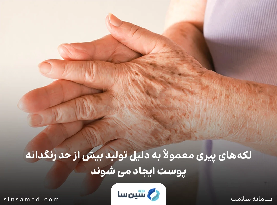تشکیل لکه های پیری در نتیجه تولید بیش از حد رنگدانه در پوست