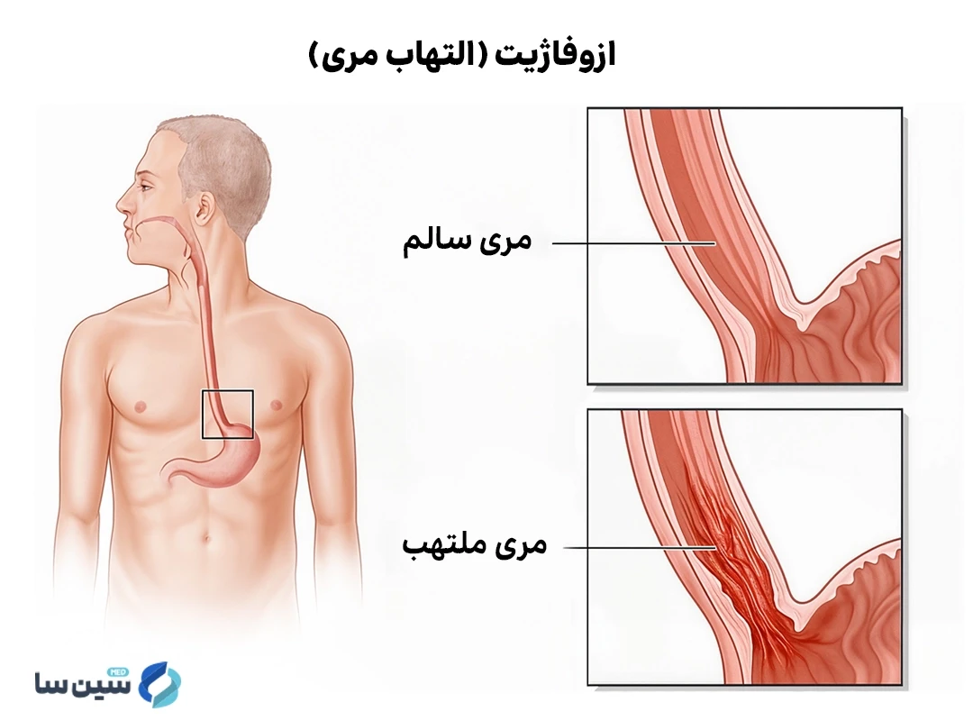 ازوفاژیت (التهاب مری) چیست؟