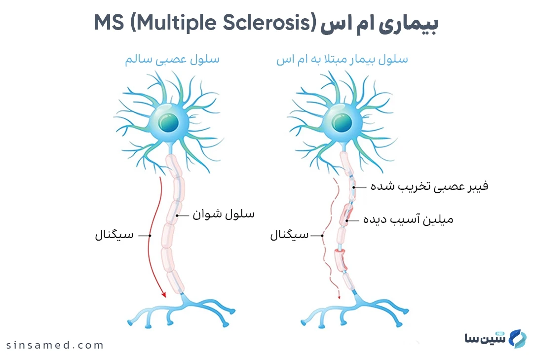 ام اس (مالتیپل اسکلروزیس)