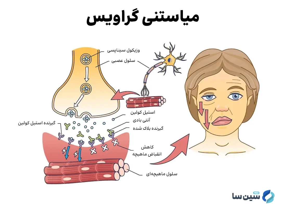 تخریب گیرنده های عصبی استیل کولین از علل ابتلا به میاستنی گراویس