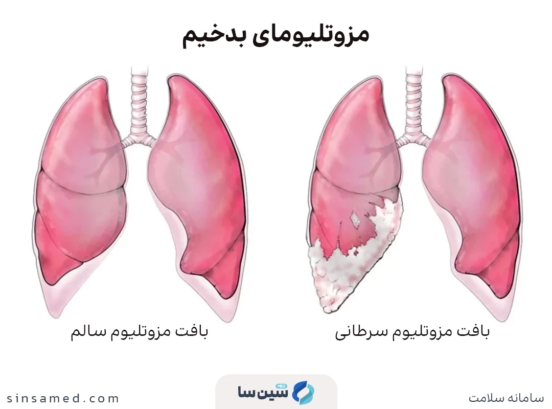 مزوتلیومای بدخیم چیست؟