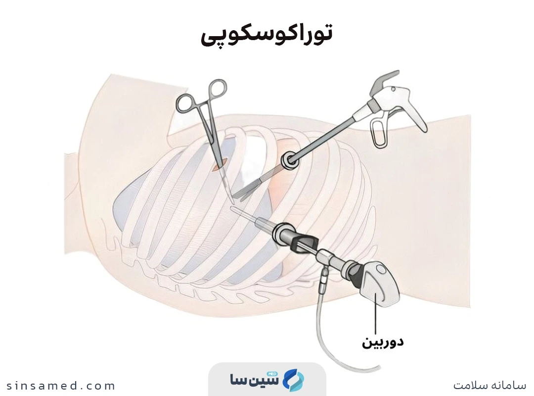 تشخیص مزوتلیومای بدخیم با انجام آزمایش توراکوسکوپی 