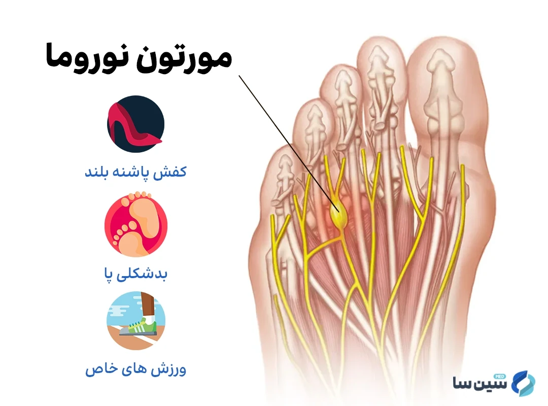 کفش پاشنه بلند و بد شکلی پا از علل ابتلا به مورتون نوروما
