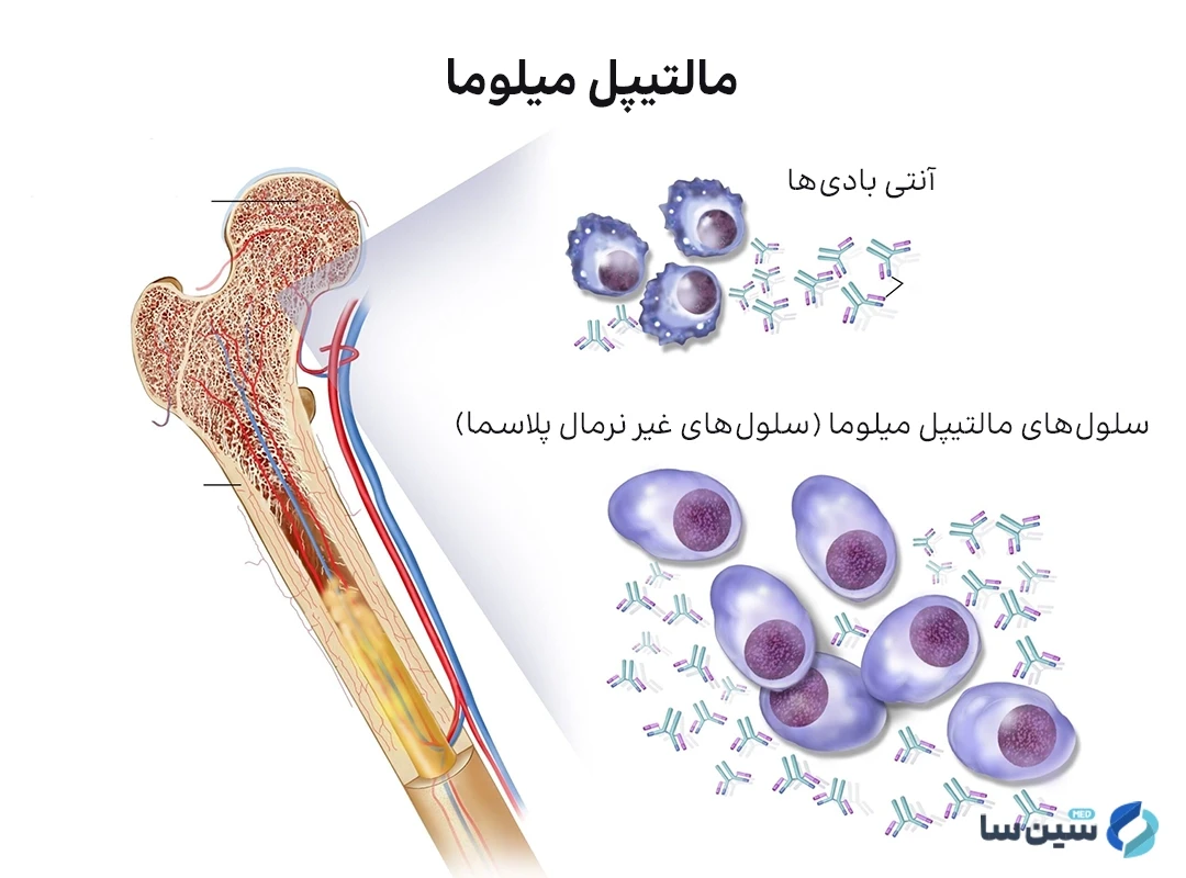 علل ابتلا به مالتیپل میلوما
