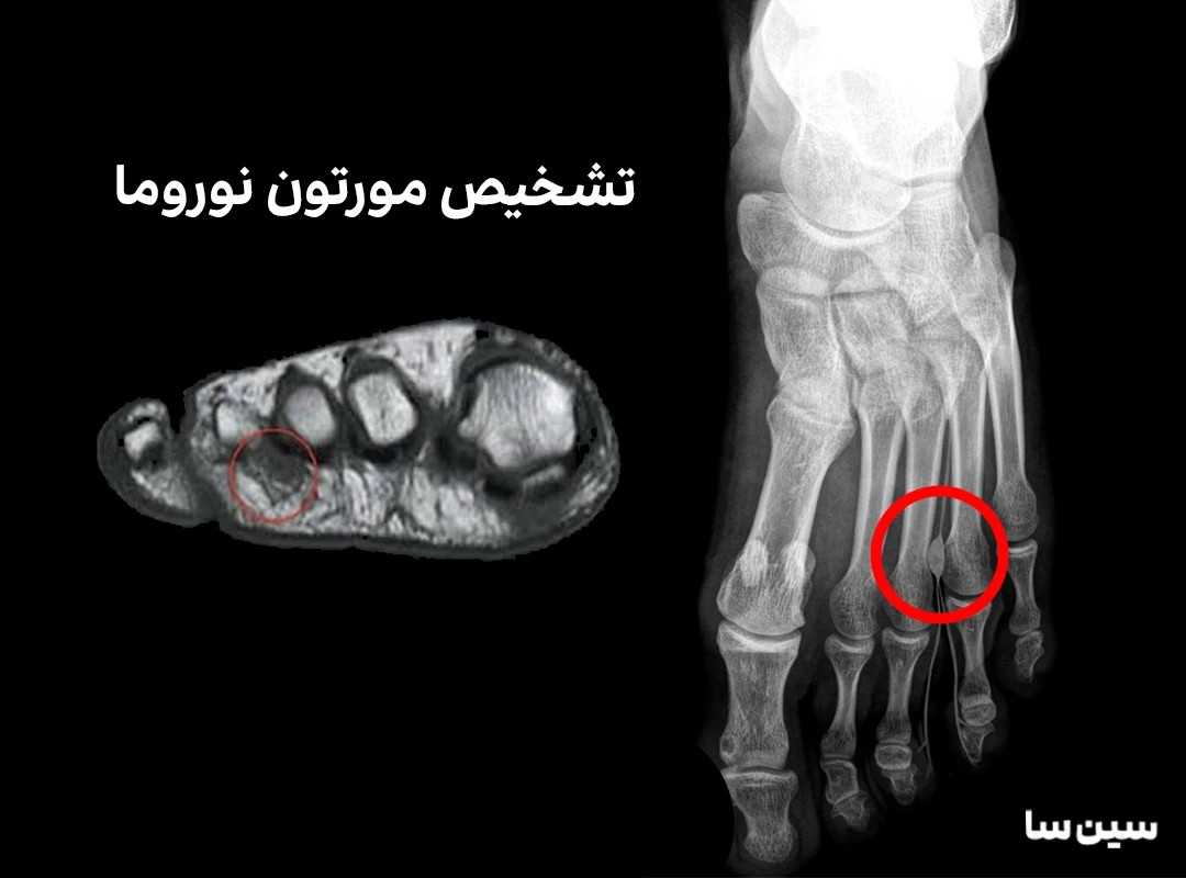 تشخیص مورتون نوروما با انجام آزمایش های تصویر برداری