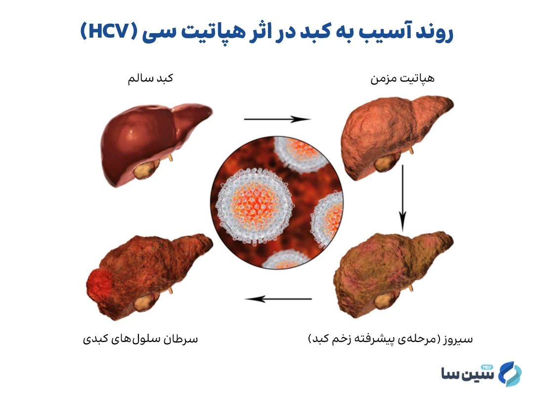 روند آسیب به کبد در اثر هپاتیت سی (HCV)