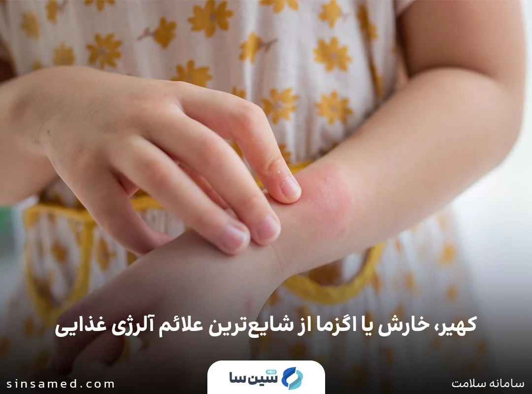 کهیر و خارش از علائم حساسیت غذایی 