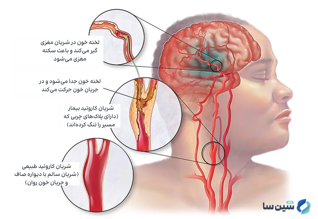 انسداد رگ های خونی از علل بروز سکته مغزی