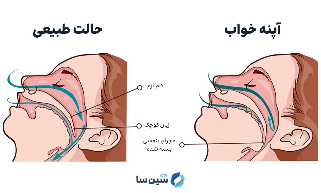 بسته شدن مجاری تنفسی از علل بروز آپنه خواب