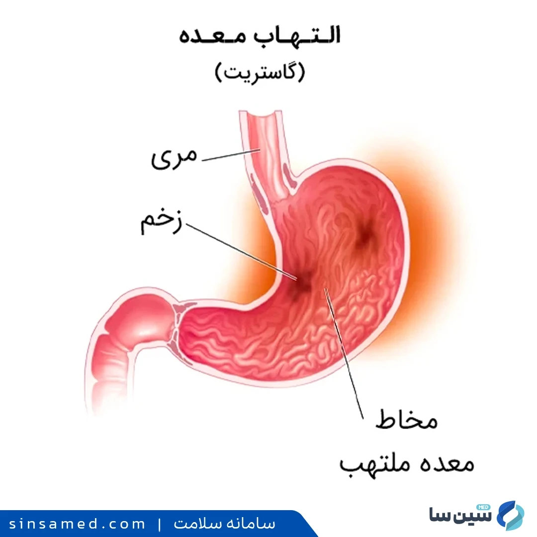زخم معده از عوارض جانبی ناپروکسن / اس امپرازول