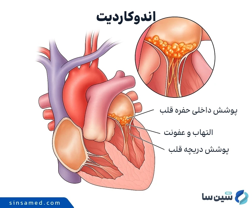 ورود باکتری ها و قارچ ها به قلب از علل ابتلا به اندوکاردیت
