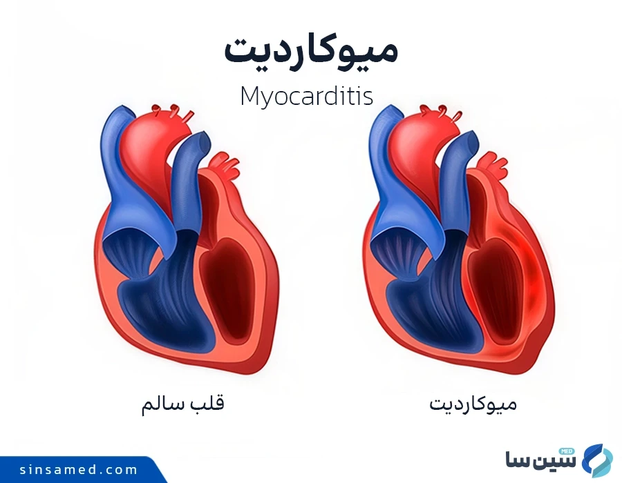 ویروس ها و باکتری ها از علل بیماری میوکاردیت