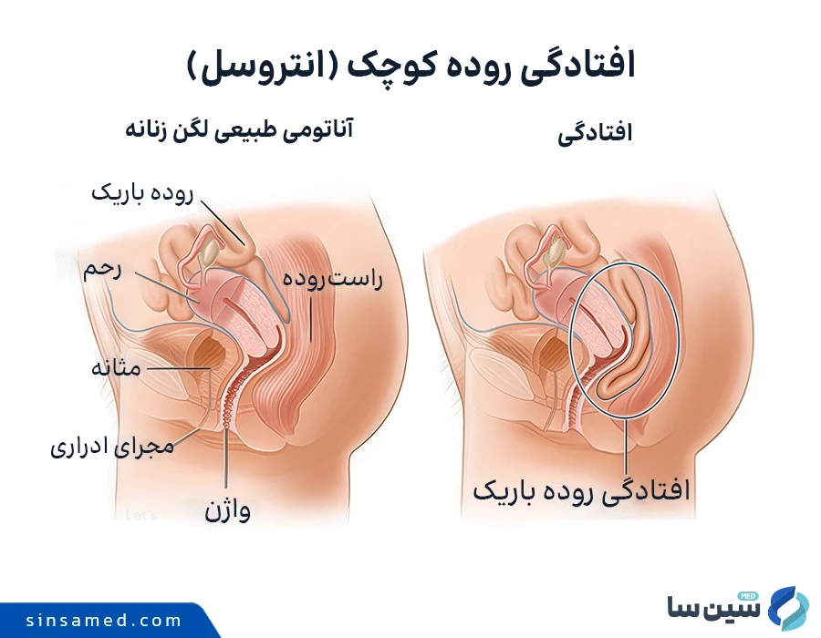 علل ابتلا به افتادگی روده کوچک (انتروسل)