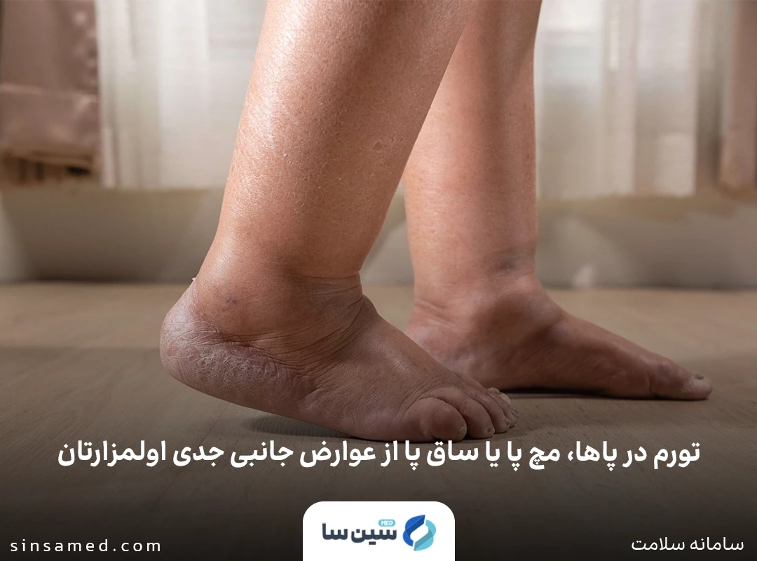 تورم پاها و مچ پا از عوارض جانبی جدی اولمسارتان
