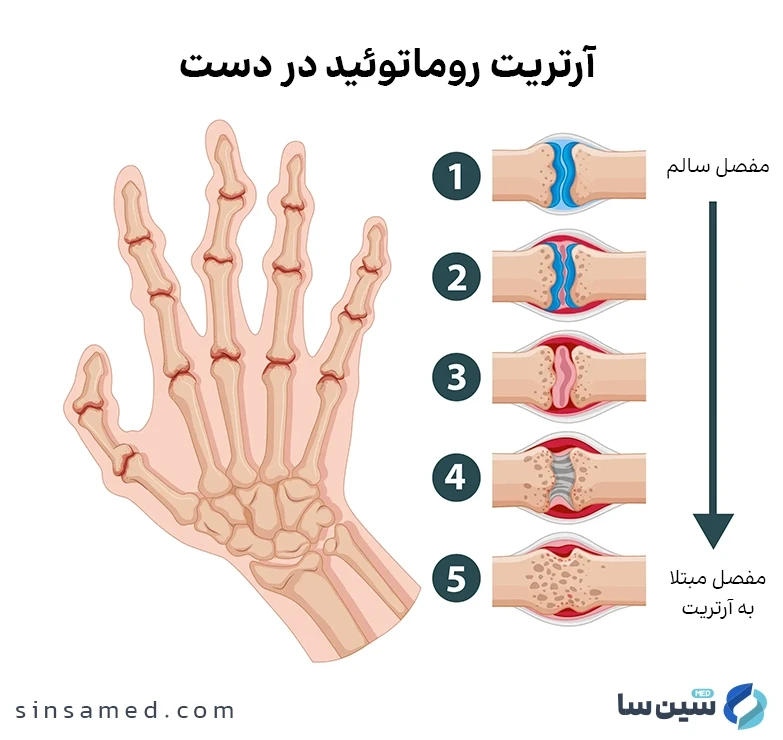 علائم روماتیسم مفصلی (آرتریت روماتوئید)