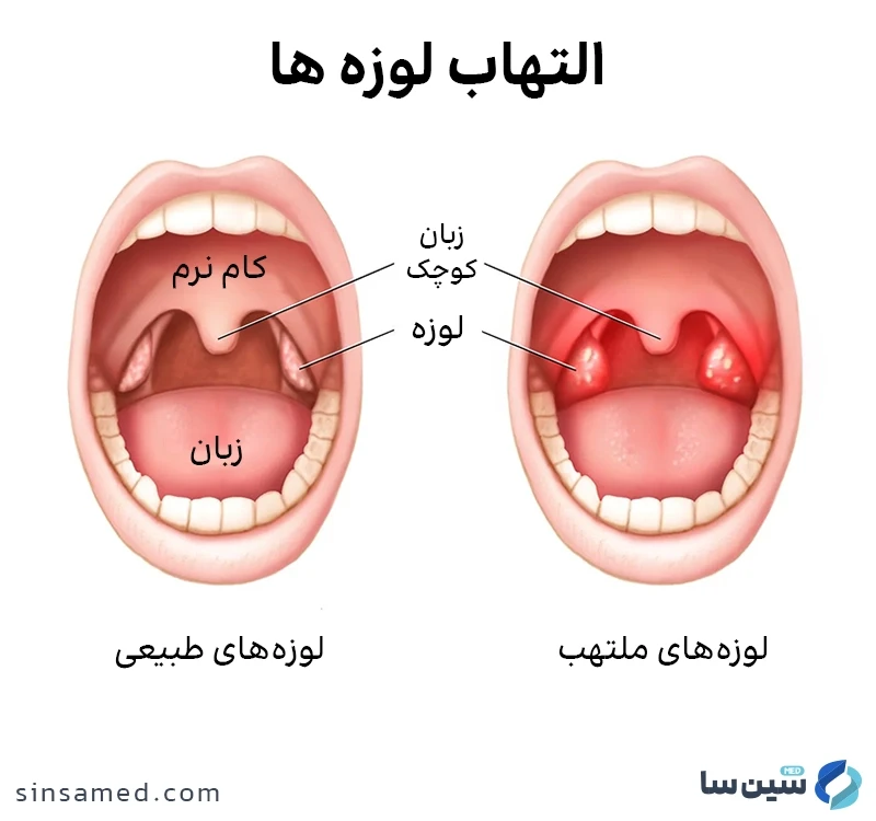 التهاب لوزه ها چیست؟