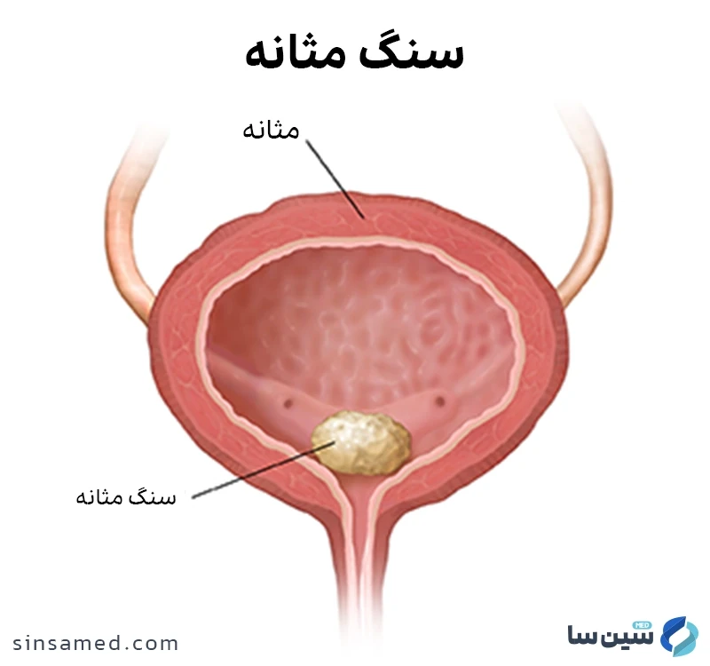 سنگ مثانه چیست؟