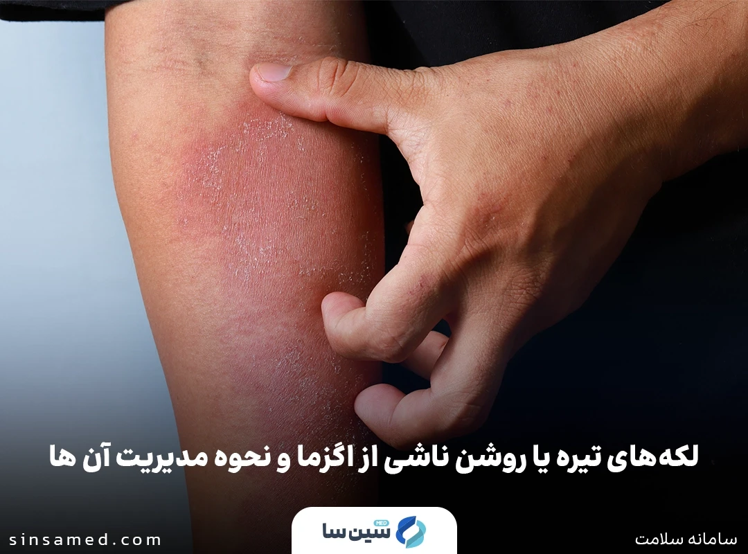 نحوه مدیریت لکه های تیره ناشی از اگزما