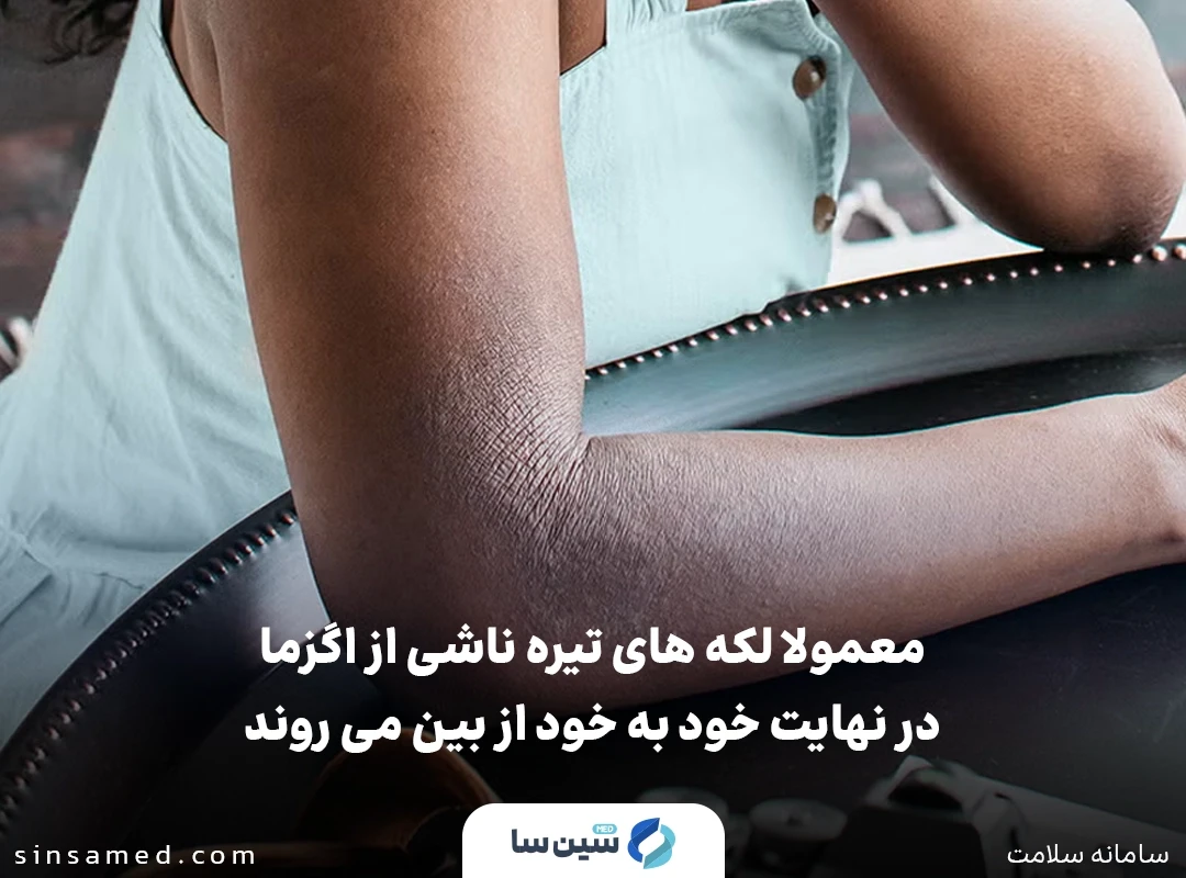 از بین رفتن لکه های تیره ناشی از اگزما به صورت خود به خودی