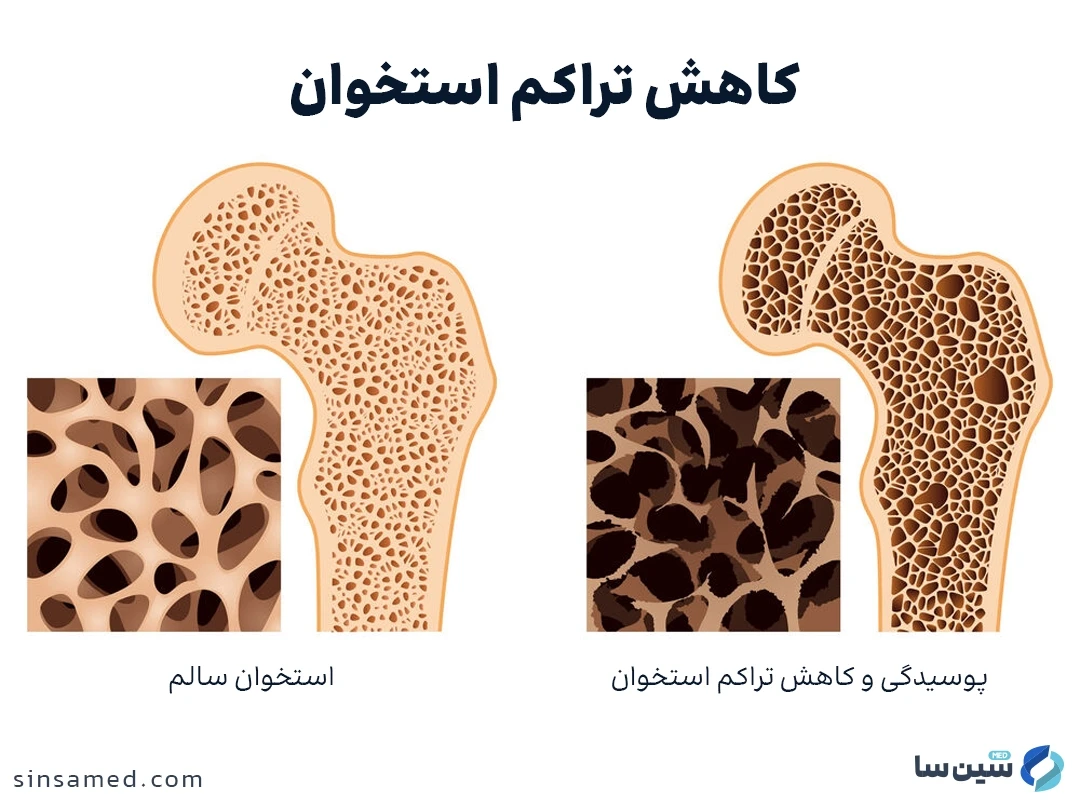 کاهش تراکم استخوان از عوارض جانبی داروی ترلژی الیپتا