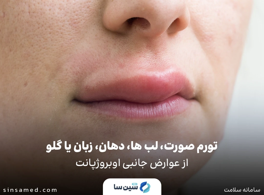 تورم صورت، لب ها و ... از عوارض جانبی داروی اوبروژپانت