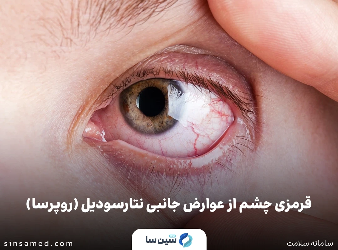 قرمزی چشم از عوارض جانبی نتارسودیل (روپرسا)