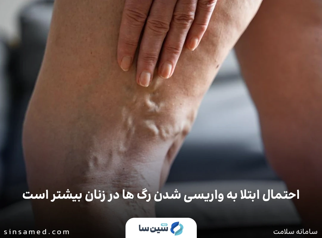احتمال بیشتر ابتلا به واریسی شدن رگ ها در زنان
