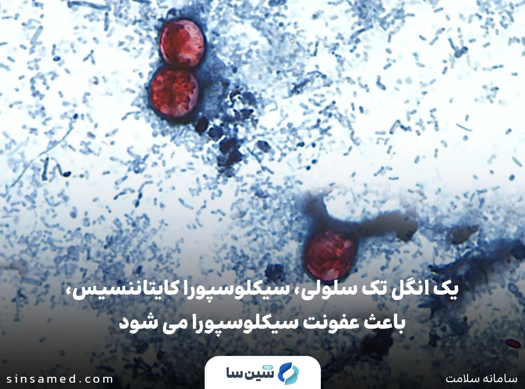 ابتلا به عفونت سیکلوسپورا (سیکلوسپوریازیس) در نتیجه فعالیت نوعی انگل تک سلولی