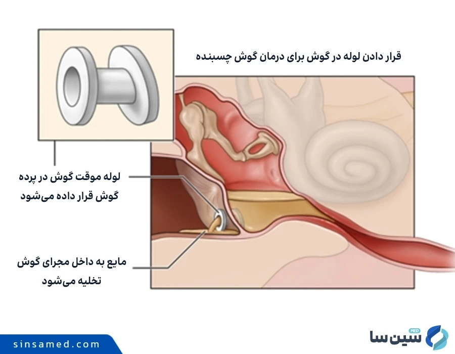 قرار دادن لوله در گوش برای درمان عارضه گوش چسبنده