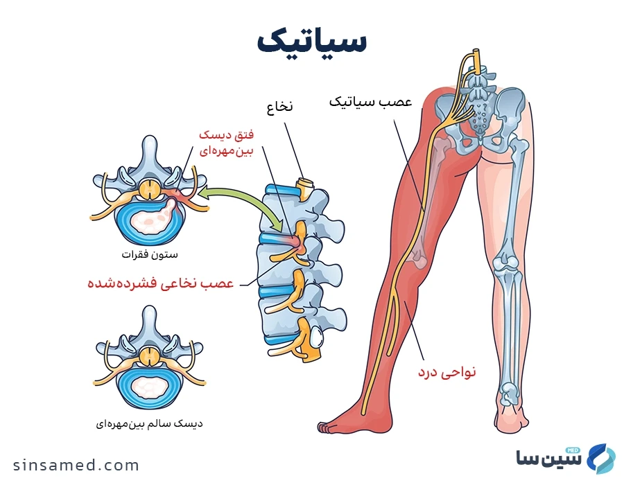درد عصب سیاتیک در نتیجه فشار به عصب نخاعی