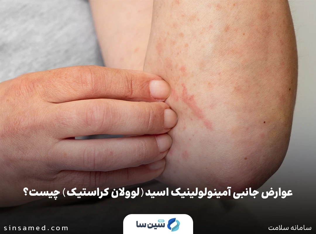 قرمزی و تورم پوست از عوارض جانبی آمینولوولینیک اسید
