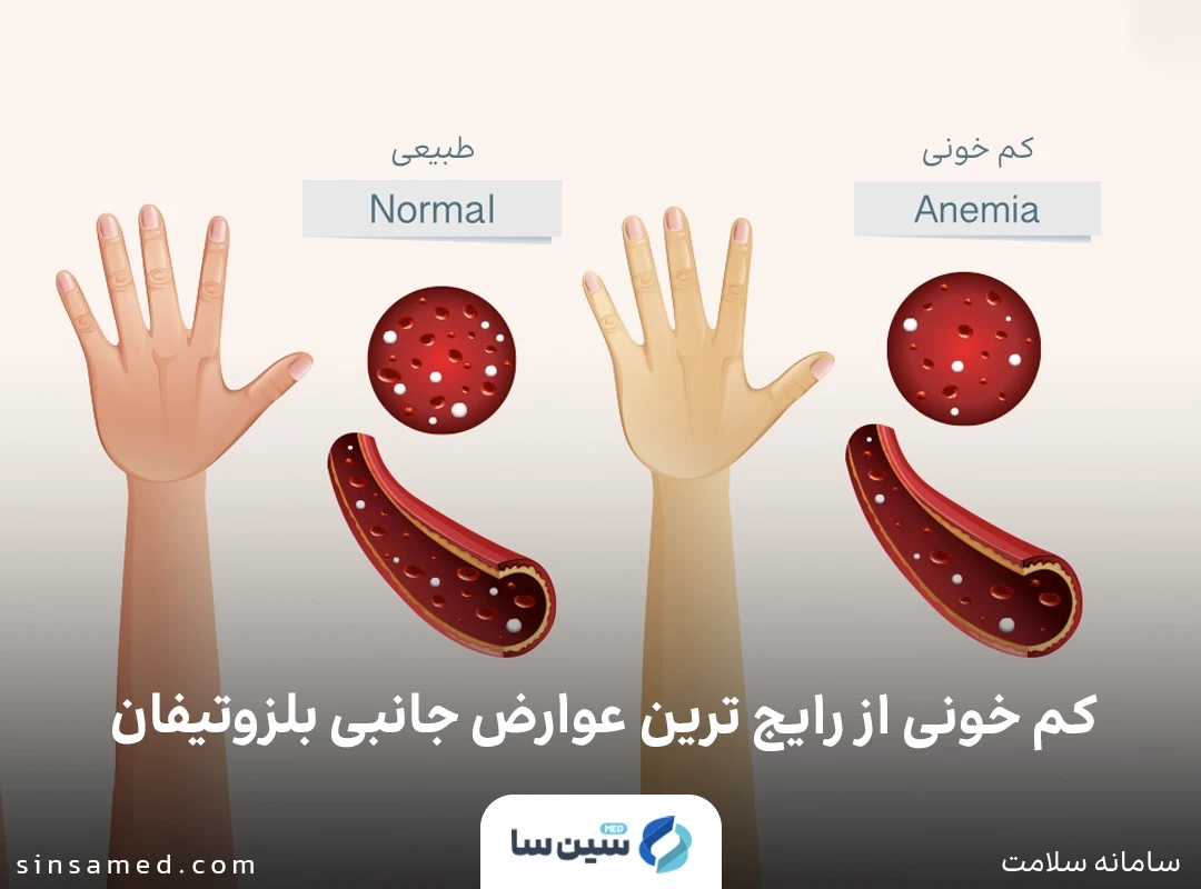 کم خونی از رایج ترین عوارض جانبی بلزوتیفان