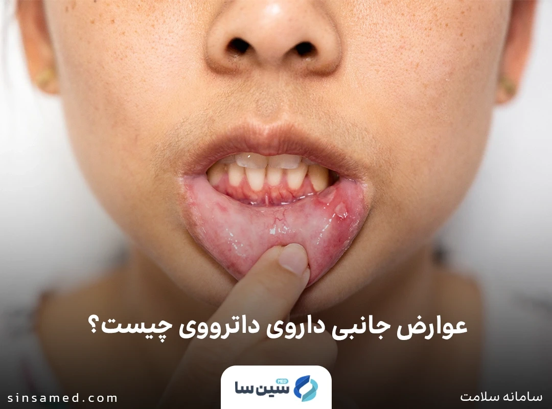 زخم های دهانی از عوارض جانبی داروی داترووی 