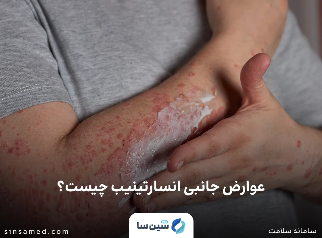 مشکلات پوستی از عوارض جانبی انسارتینیب